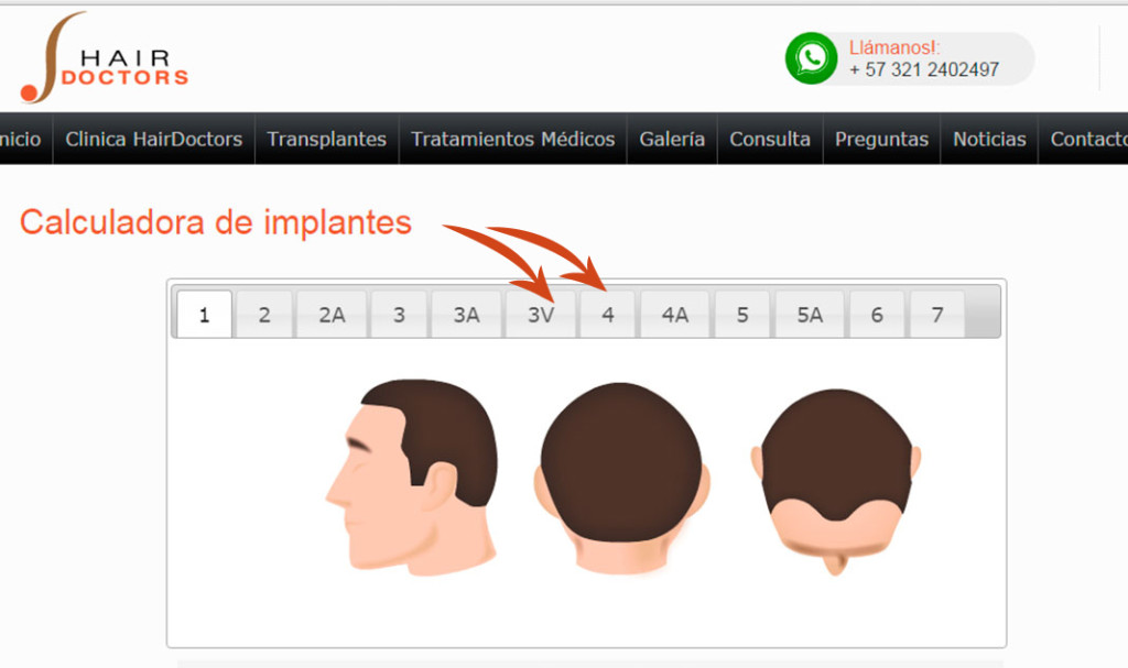 implante capilar, costo de un implante capilar, precio de un implante capilar colombia, precios implantes de pelo colombia, implante capilar bogotá