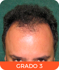 Alopecia grado 3