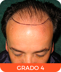 Alopecia grado 4