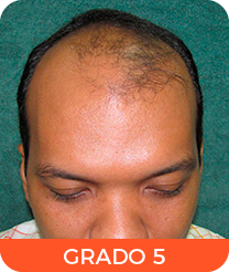 Alopecia grado 5