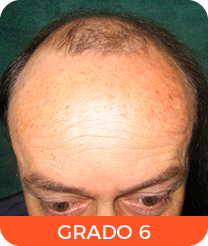 Alopecia grado 6