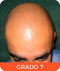 Alopecia grado 7